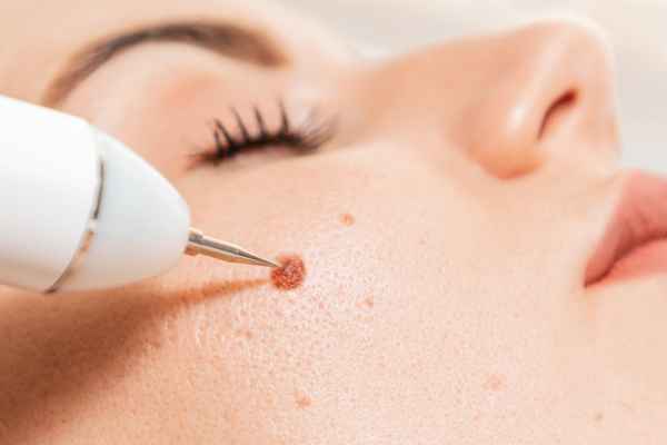 CryoPen: 5 Skin Concerns It May Be Used to Treat 3 What actually happens during a CryoPen treatment Bridport?