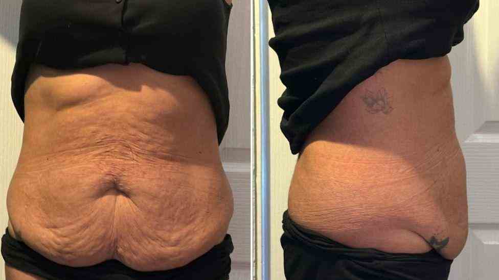 Lost the Weight but Not the Loose Skin? What You Should Know 1 Is It Definitely Loose Skin Bridport?